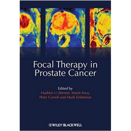 Focal Therapy in Prostate Cancer 1st Edition