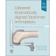 Calipered Kinematically aligned Total Knee Arthroplasty
