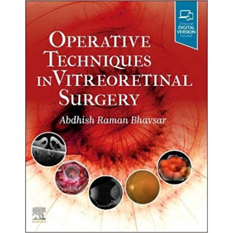 Operative Techniques in Vitreoretinal Surgery
