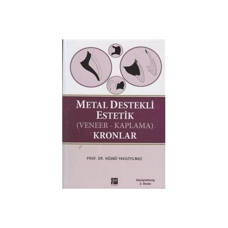 Metal Destekli Estetik (Veneer-Kaplama) Kronlar