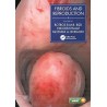 Fibroids and Reproduction