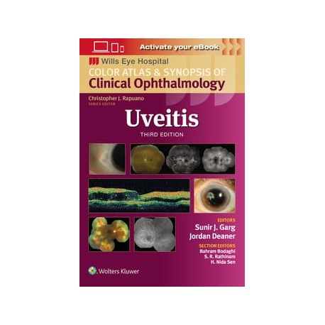 Uveitis,3 Edition