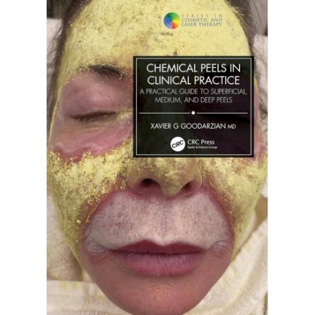 Chemical Peels in Clinical Practice A Practical Guide to Superficial, Medium, and Deep Peels Chemical Peels in Clinical Practice A Practical Guide to Superficial, Medium, and Deep Peels