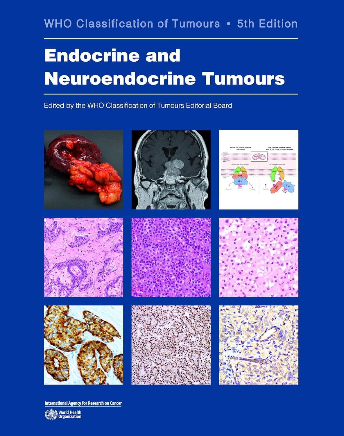 Endocrine and Neuroendocrine Tumours WHO Classification of