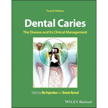 Dental Caries: The Disease and its Clinical Management,4th Edition