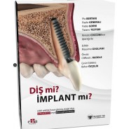 Diş mi? İmplant mı? (Doğal Dişin Korunması veya İmplant Çözümleri Üzerine Kapsamlı Rehber)