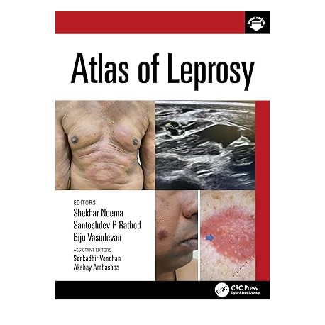 Atlas of Leprosy Atlas of Leprosy