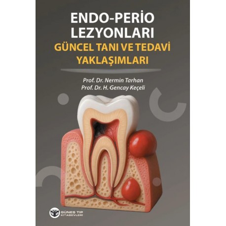 Endo - Perio Lezyonları Güncel Tanı ve Tedavi Yaklaşımları