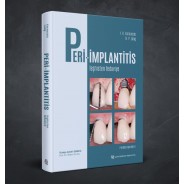 PERİ-İMPLANTİTİS Teşhisten Tedaviye