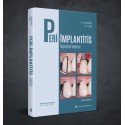 PERİ-İMPLANTİTİS Teşhisten Tedaviye
